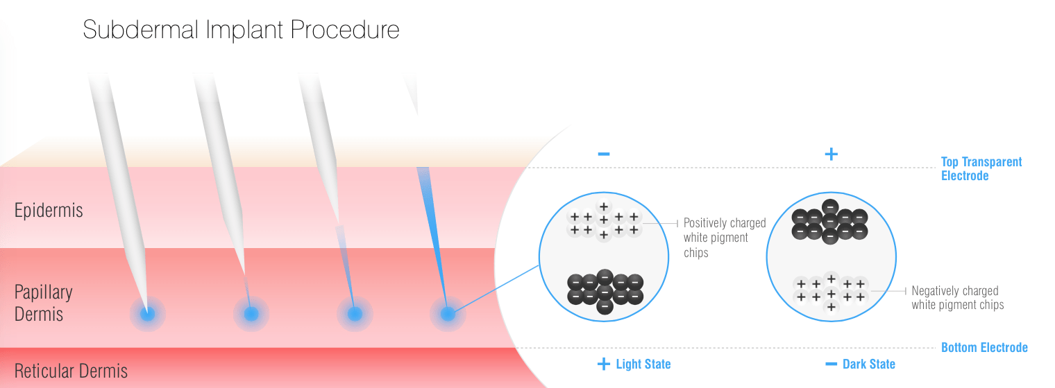 Subdermal implant procedure